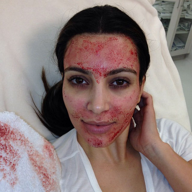 Kim Kardashian mantm sua beleza injetando sangue no rosto