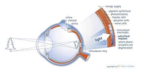 Implante retina