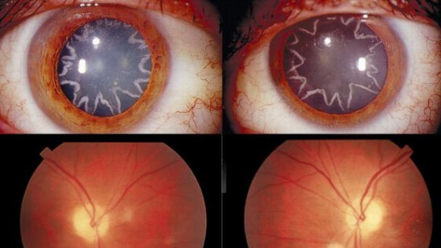 Homem desenvolve catarata nos olhos em forma de estrela