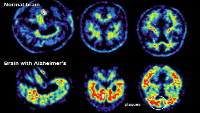 Droga contra o cncer consegue curar o Alzheimer em 6 horas